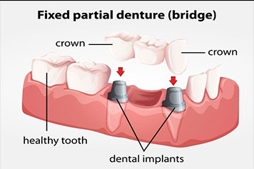 Crown implants.