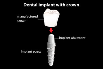 Representative picture of the same day procedure.