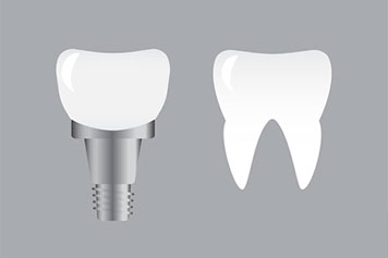 Zirconia implants.